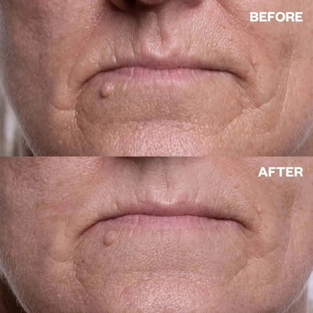 Mouth & Lip Wrinkle Patches Wrinkles Schminkles
