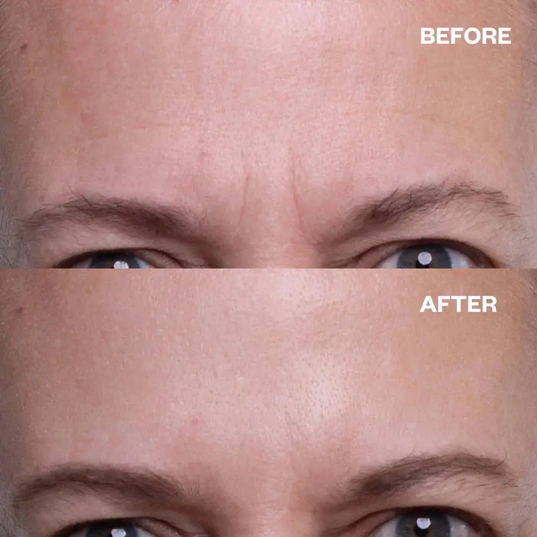 Forehead Wrinkle Patches Wrinkles Schminkles